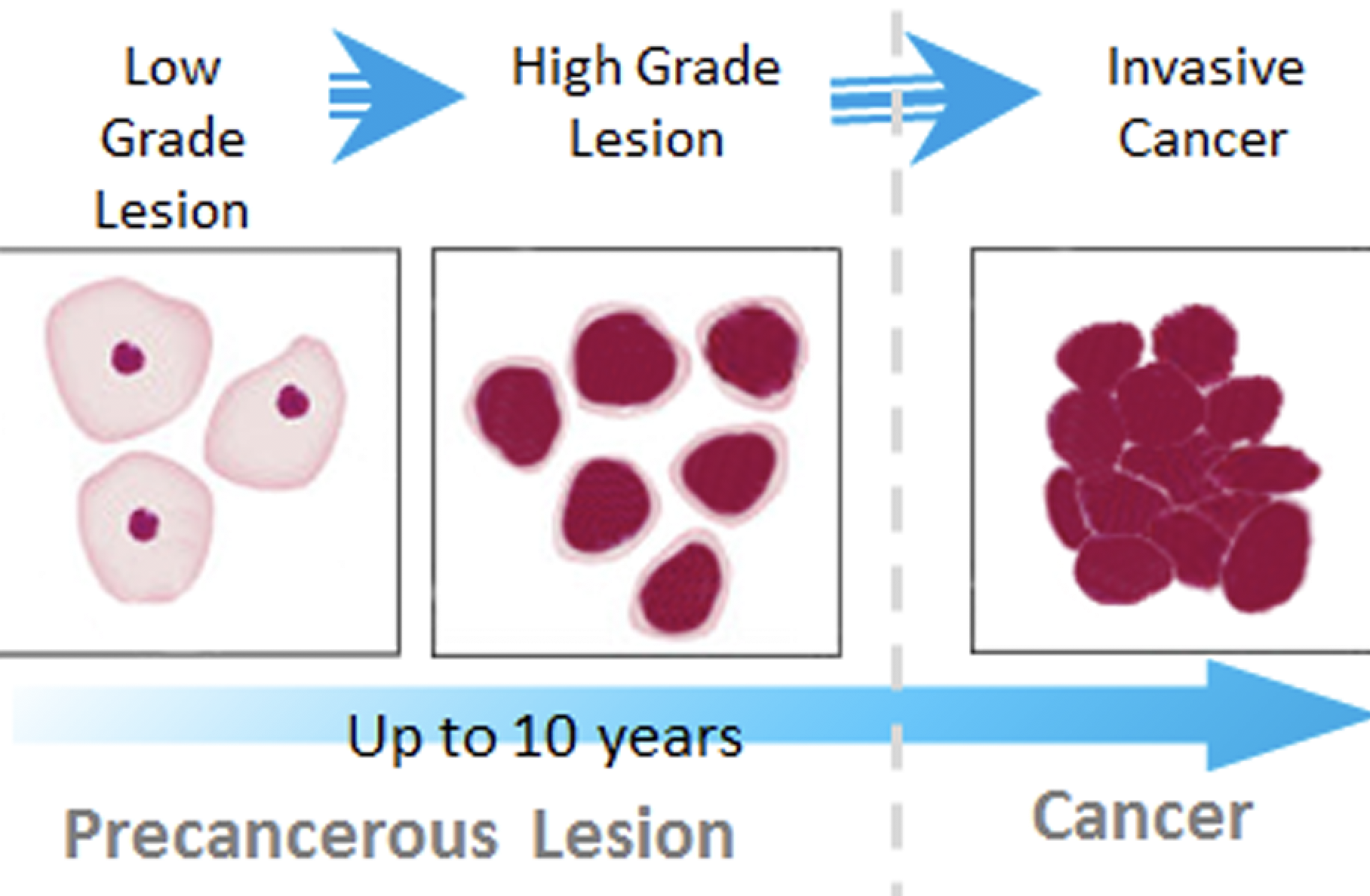 HPV & Cancer - FidaLab